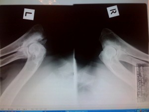 Baldr's Elbows