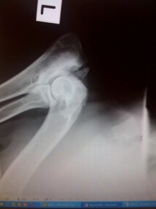 Baldr's Left Elbow